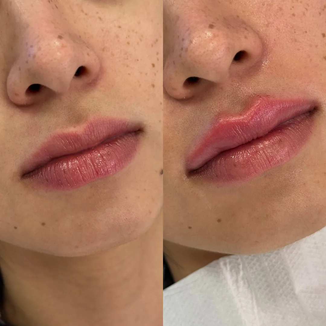 Preenchimento labial: antes à esquerda, depois à direita