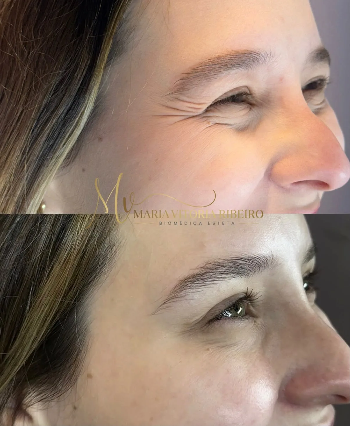 Botox: antes e depois das linhas ao redor dos olhos