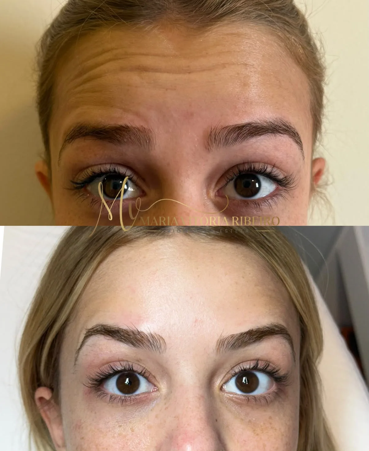 Botox: antes e depois das linhas da testa