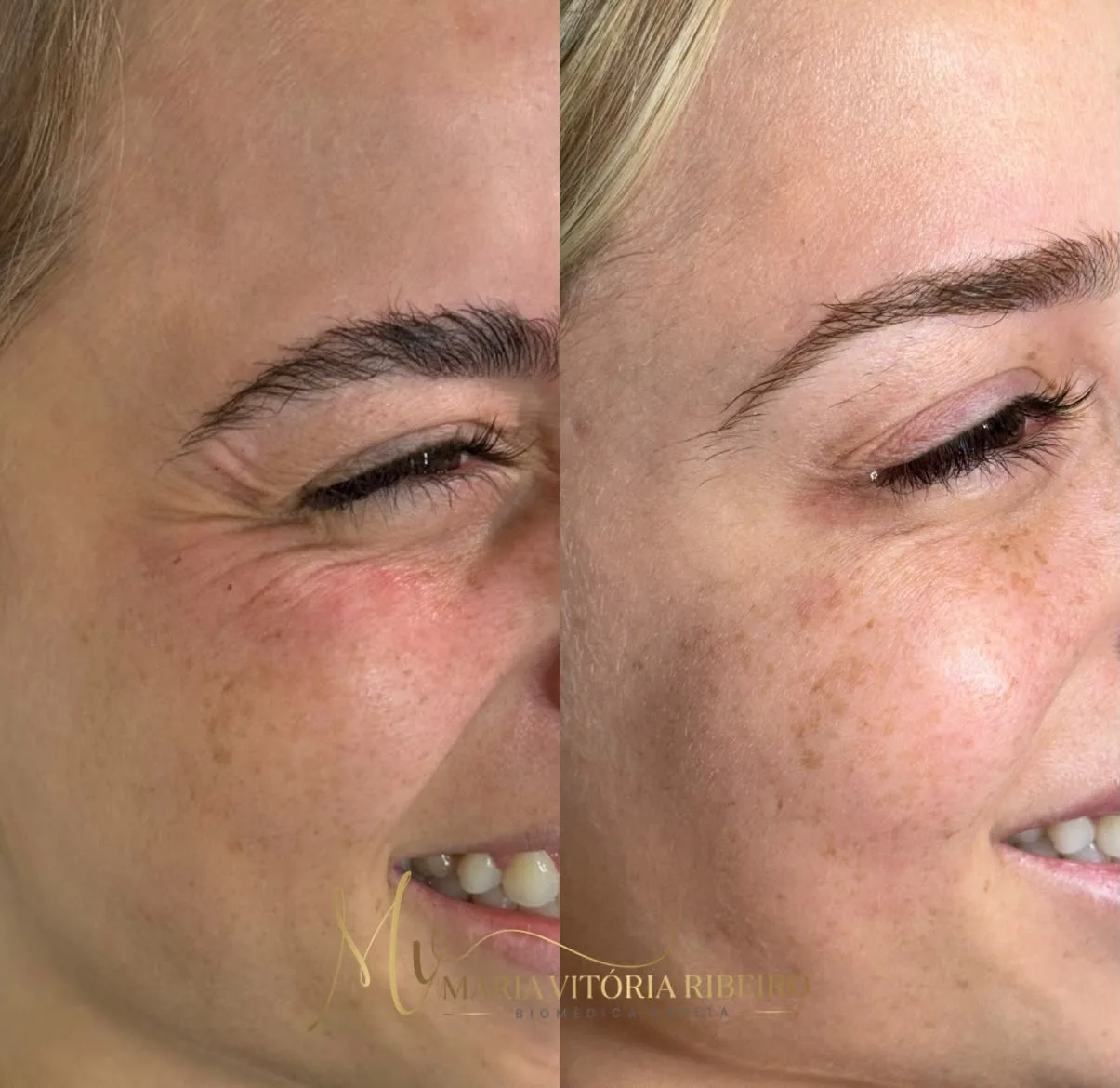 Botox: antes e depois das linhas ao redor dos olhos, lado a lado