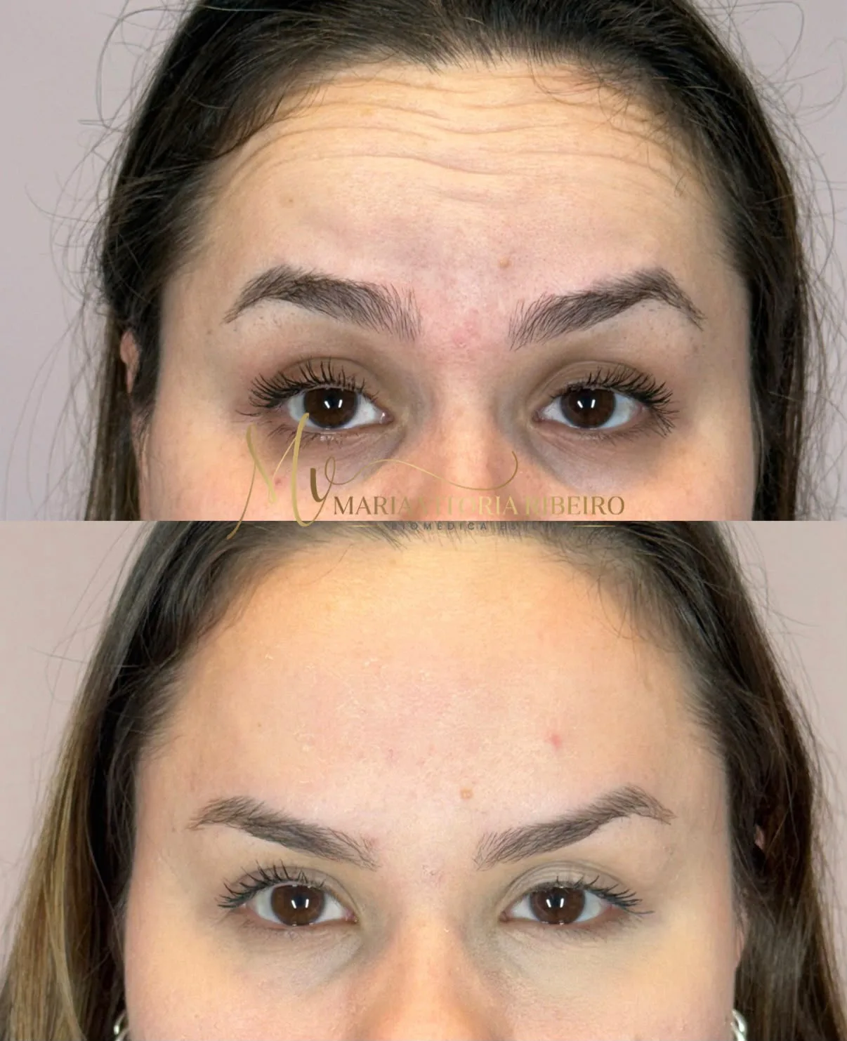 Botox: antes e depois da testa e entre as sobrancelhas