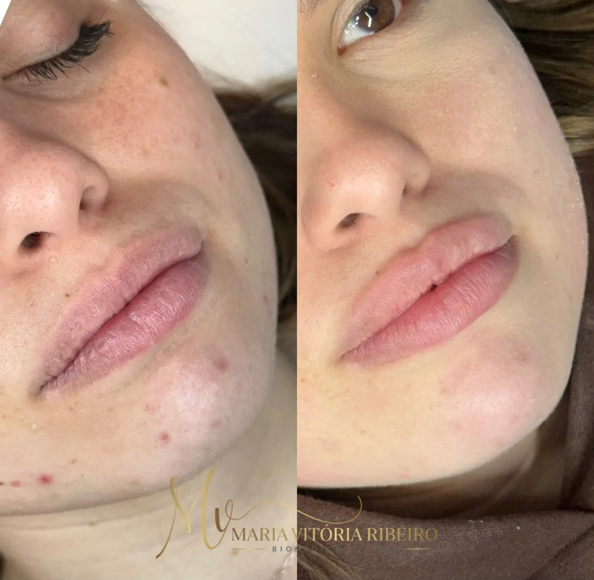 Preenchimento labial: antes e depois, lado a lado