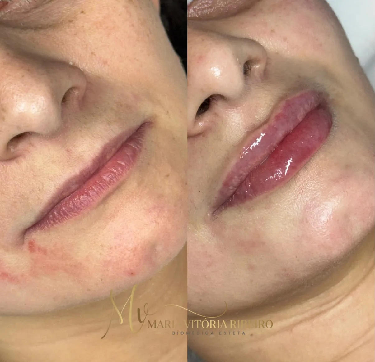 Preenchimento labial: antes e depois, de perfil