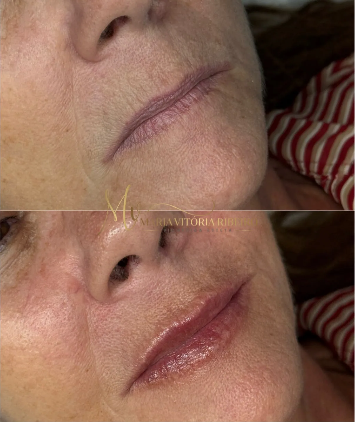 Preenchimento labial em paciente madura: lábios finos antes, contorno e volume definidos depois