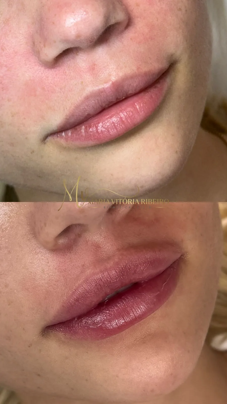 Lábios: antes e depois, um embaixo do outro