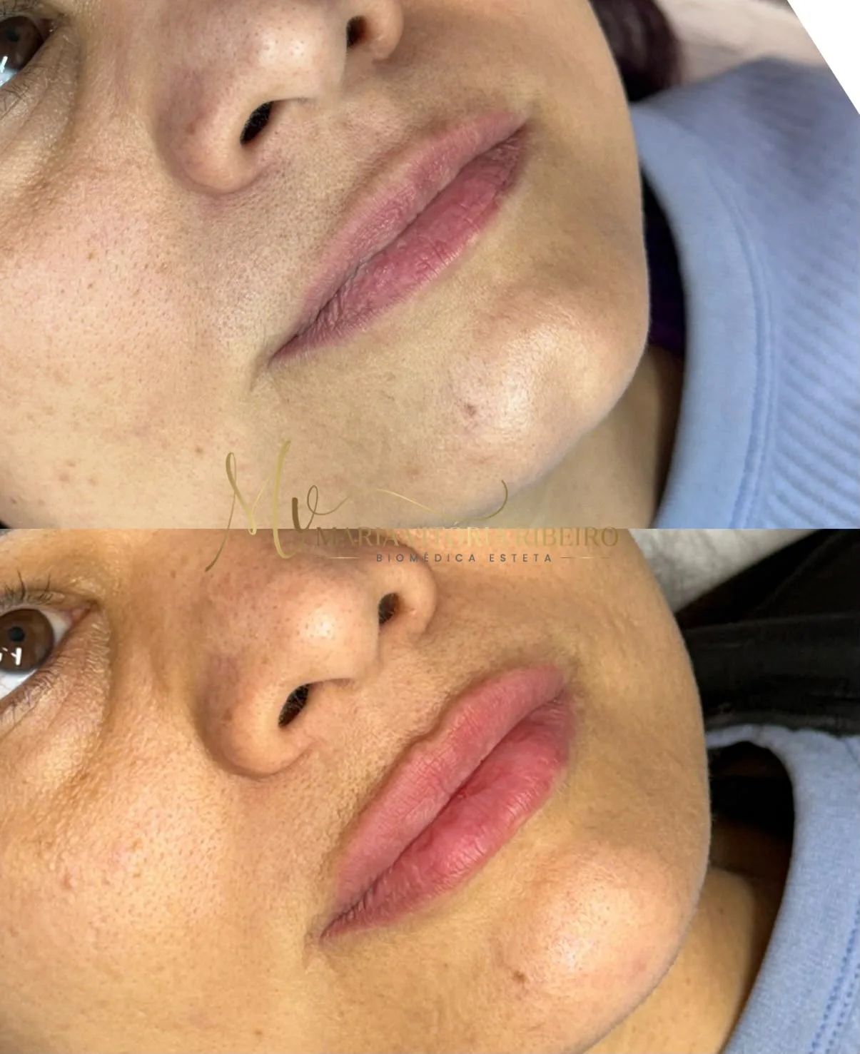 Preenchimento labial: antes em cima, depois embaixo, de três quartos