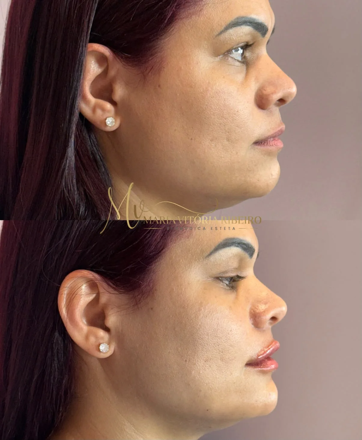 Perfil: antes e depois, rosto de lado
