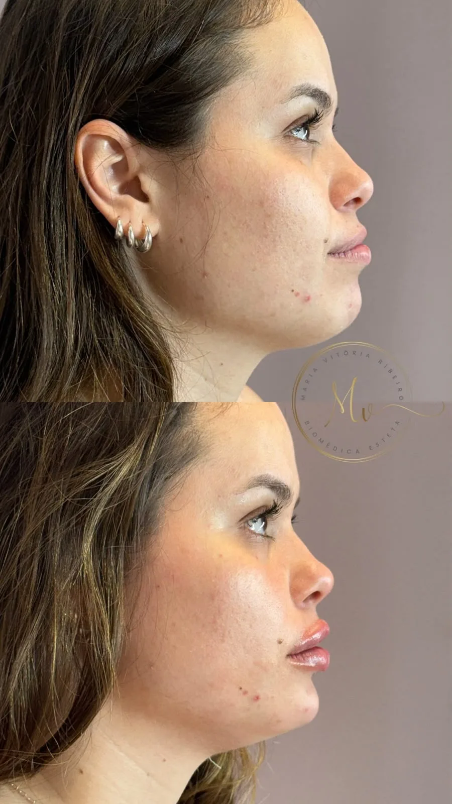 Perfil: antes e depois, rosto de lado